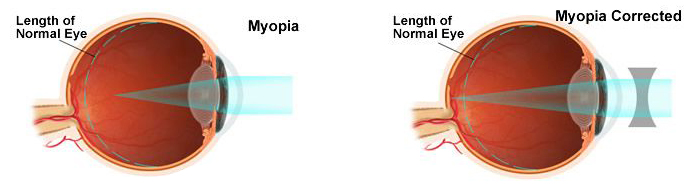 Short-Sightedness (Myopia)