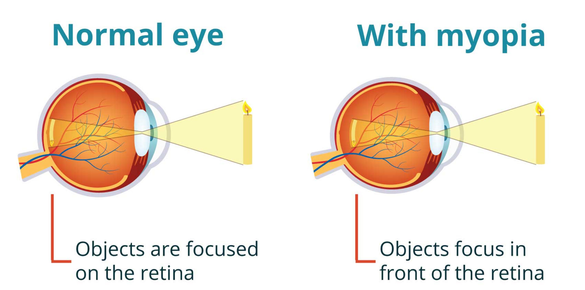 normal and myopia eye
